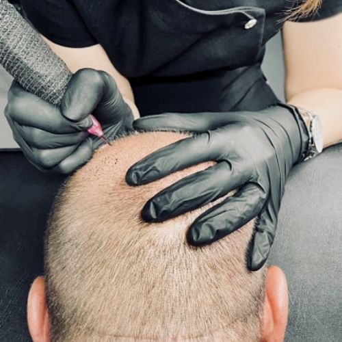Tricopigmentation à Grésy sur Aix ODB Concept