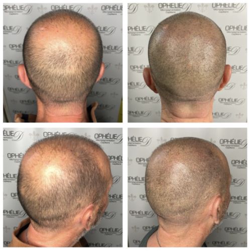 Tricopigmentation à Grésy sur Aix ODB Concept