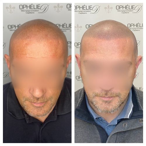 Tricopigmentation à Grésy sur Aix ODB Concept