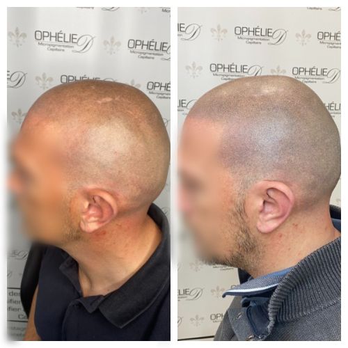 Tricopigmentation à Grésy sur Aix ODB Concept