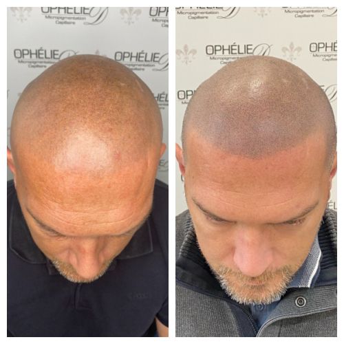 Tricopigmentation à Grésy sur Aix ODB Concept