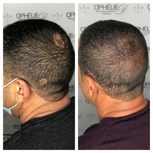 Tricopigmentation à Grésy sur Aix ODB Concept