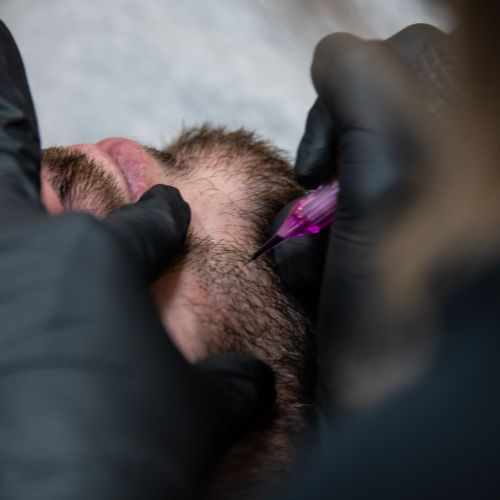 Tricopigmentation à Grésy sur Aix ODB Concept