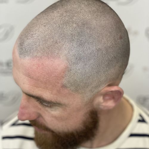 Tricopigmentation à Grésy sur Aix ODB Concept