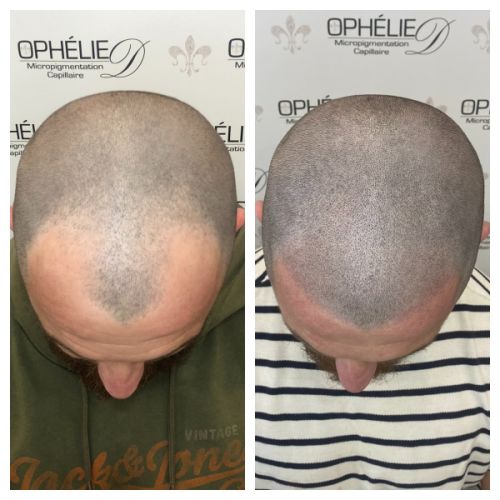 Tricopigmentation à Grésy sur Aix ODB Concept
