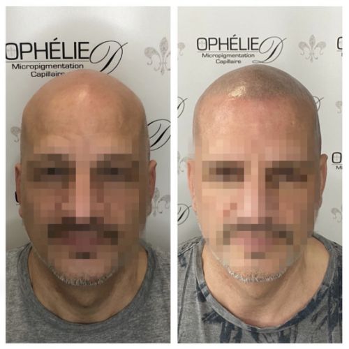 Tricopigmentation à Grésy sur Aix ODB Concept