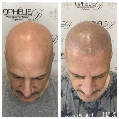 Tricopigmentation à Grésy sur Aix ODB Concept