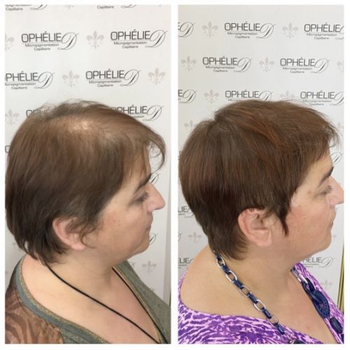 Tricopigmentation à Grésy sur Aix ODB Concept