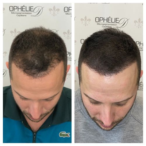 Tricopigmentation à Grésy sur Aix ODB Concept