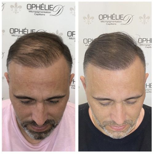 Tricopigmentation à Grésy sur Aix ODB Concept