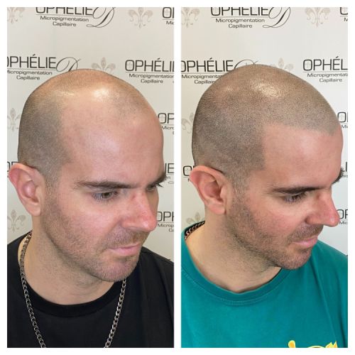 Tricopigmentation à Grésy sur Aix ODB Concept