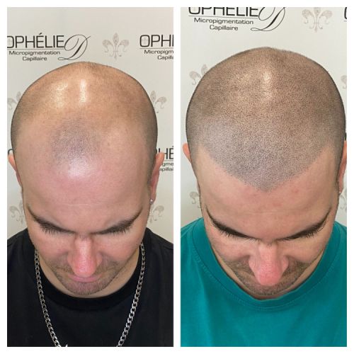 Tricopigmentation à Grésy sur Aix ODB Concept