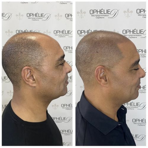 Tricopigmentation à Grésy sur Aix ODB Concept