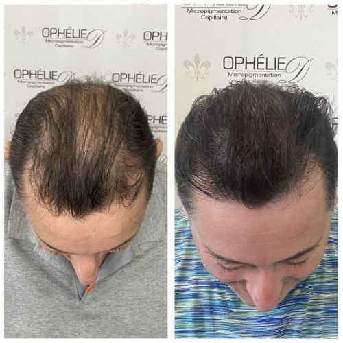 Tricopigmentation à Grésy sur Aix ODB Concept