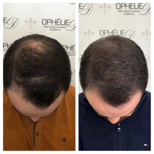 Tricopigmentation à Grésy sur Aix ODB Concept