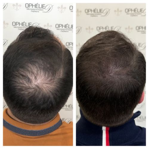 Tricopigmentation à Grésy sur Aix ODB Concept