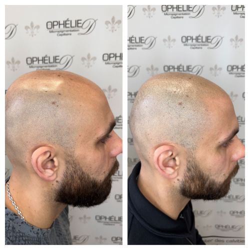 Tricopigmentation à Grésy sur Aix ODB Concept