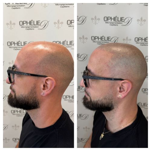 Tricopigmentation à Grésy sur Aix ODB Concept