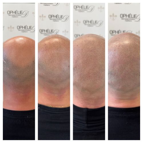 Tricopigmentation à Grésy sur Aix ODB Concept