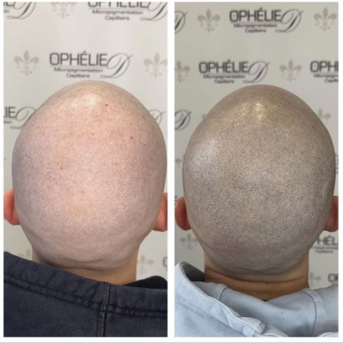 Tricopigmentation à Grésy sur Aix ODB Concept