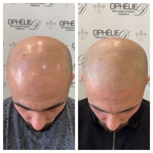 Tricopigmentation à Grésy sur Aix ODB Concept