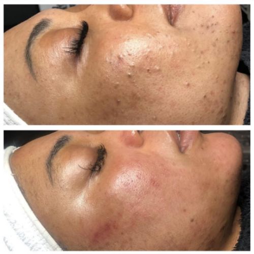 Soins nettoyants de la peau institut de beauté à Grésy sur Aix