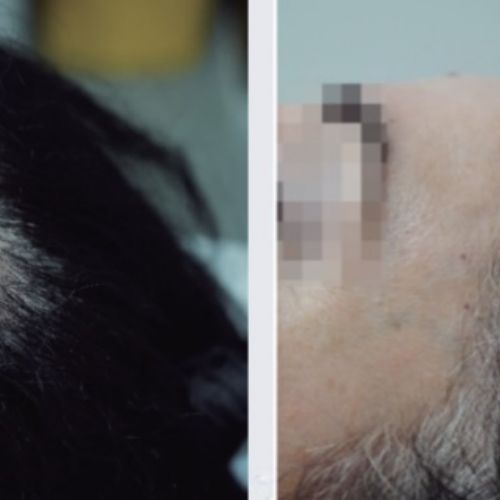 Tricologie - ODB Concept salon de coiffure à Grésy sur Aix