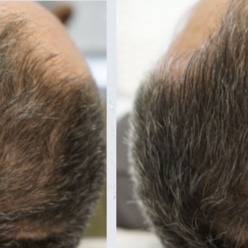 Tricologie - ODB Concept salon de coiffure à Grésy sur Aix