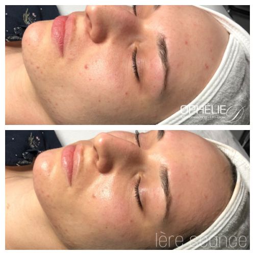 Soins traitants de la peau - Institut de beauté à Grésy sur Aix