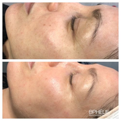 Soins traitants de la peau - Institut de beauté à Grésy sur Aix