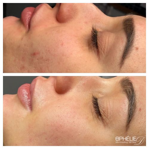 Soins traitants de la peau - Institut de beauté à Grésy sur Aix