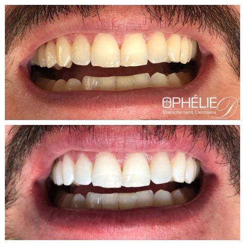 Blanchiment dentaire à Grésy Sur Aix - ODB Concept