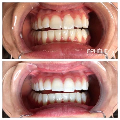 Blanchiment dentaire à Grésy Sur Aix - ODB Concept