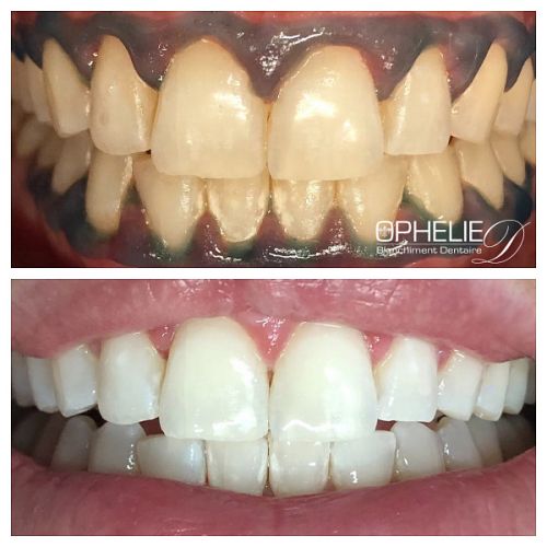 Blanchiment dentaire à Grésy Sur Aix - ODB Concept