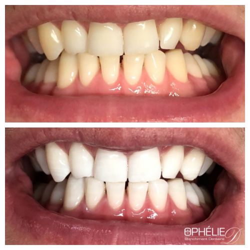 Blanchiment dentaire à Grésy Sur Aix - ODB Concept