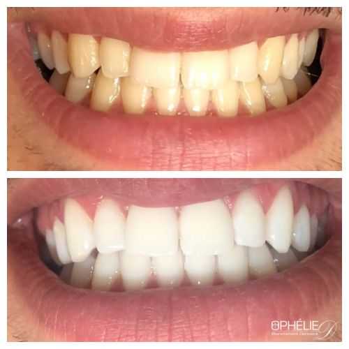 Blanchiment dentaire à Grésy Sur Aix - ODB Concept