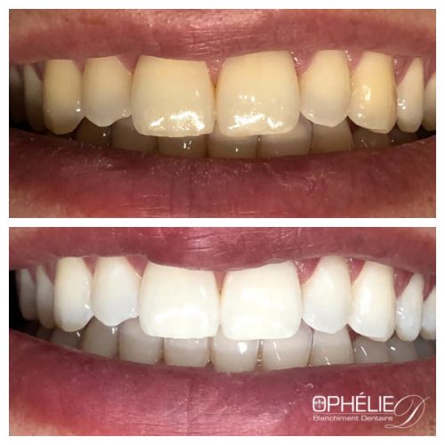 Blanchiment dentaire à Grésy Sur Aix - ODB Concept