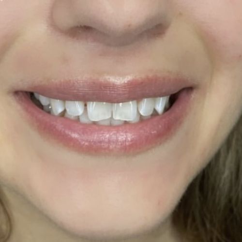 Blanchiment dentaire à Grésy Sur Aix - ODB Concept