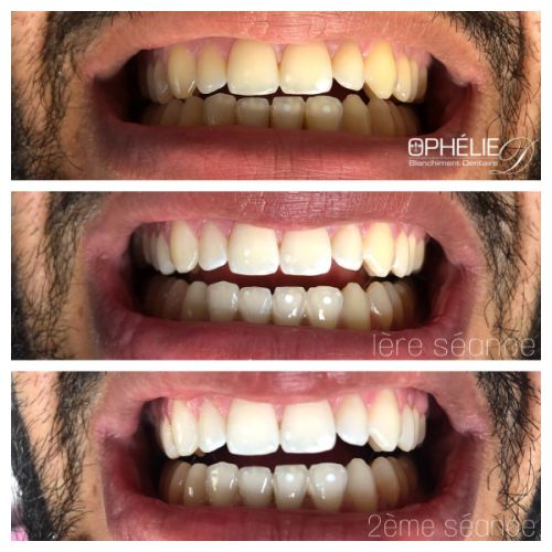 Blanchiment dentaire à Grésy Sur Aix - ODB Concept