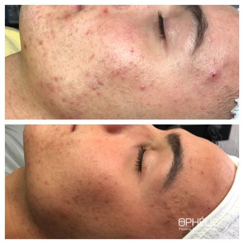 Soins traitants de la peau - Institut de beauté à Grésy sur Aix