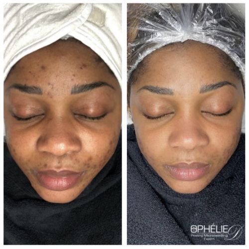 Soins traitants de la peau - Institut de beauté à Grésy sur Aix