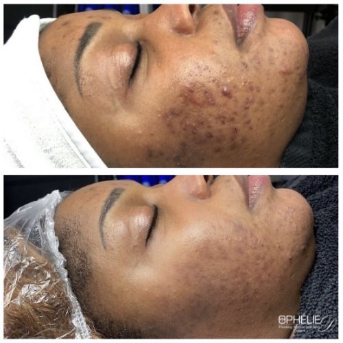 Soins traitants de la peau - Institut de beauté à Grésy sur Aix