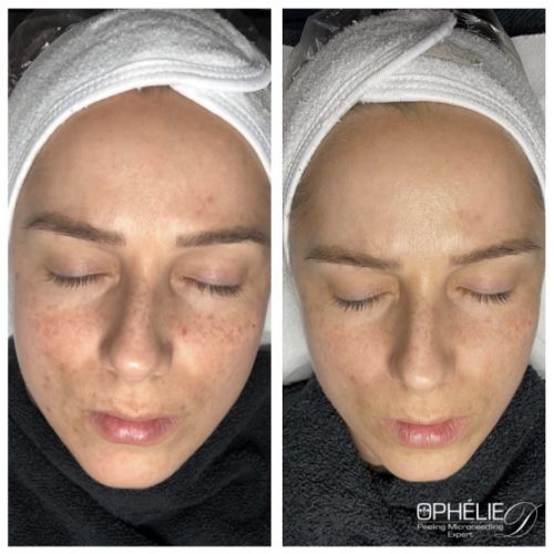 Soins traitants de la peau - Institut de beauté à Grésy sur Aix