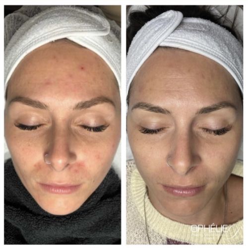 Soins traitants de la peau - Institut de beauté à Grésy sur Aix