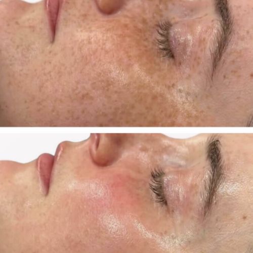 Soins traitants de la peau - Institut de beauté à Grésy sur Aix