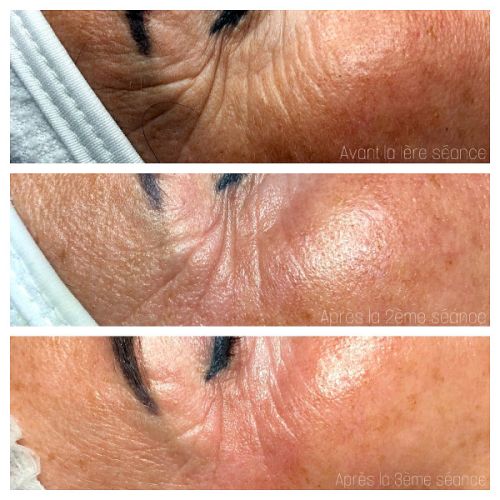 Soins traitants de la peau - Institut de beauté à Grésy sur Aix