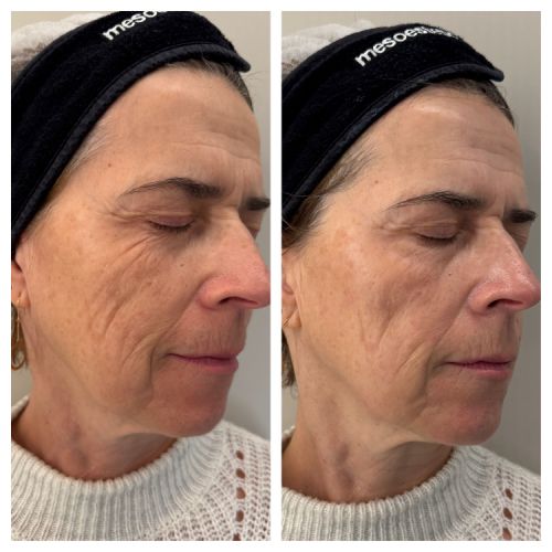 Soins traitants de la peau - Institut de beauté à Grésy sur Aix
