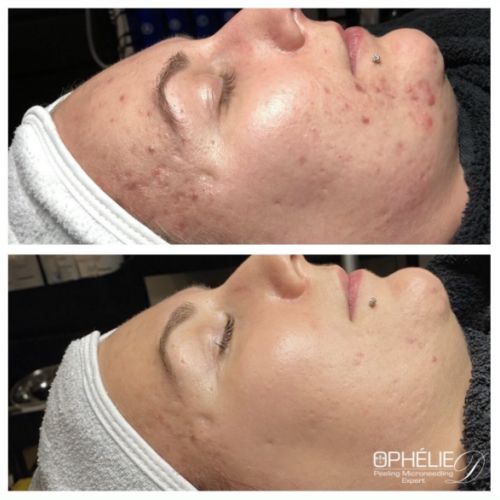 Soins traitants de la peau - Institut de beauté à Grésy sur Aix
