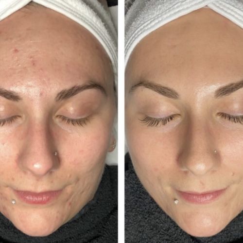 Soins traitants de la peau - Institut de beauté à Grésy sur Aix